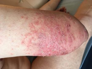 Dermatite de contact allergique