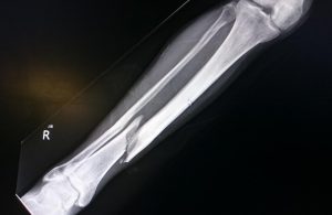 Fracture du tibia