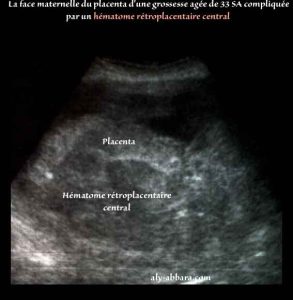 L’hématome rétro-placentaire