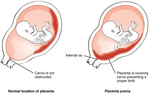 placenta praevia