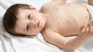 varicelle chez bébé